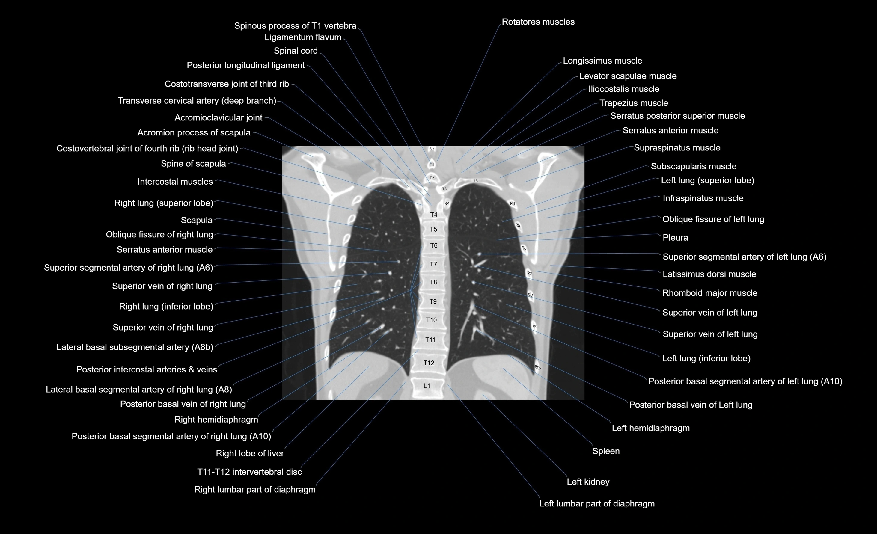 CT chest (thorax) labelled coronal cross sectional anatomy radiology image-00036.webp